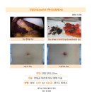 단일담석2.7cm수술후기. 만일 담낭 절제술에 대해 고민하고 계신다면 대학병원보다 튼튼병원 김정윤 원장님께 수술 받는 걸 강추... 이미지