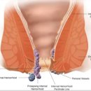 직장암(Rectal Cancer) 4기 진단과 함께 인공 항문을 하지 않아도 된 치료 케이스 이미지