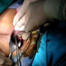 고주파치질치료기(ERF-CA,CT)의 HR-forcep+Cutting Forceps(특허출원) 을 이용한 수술장면 이미지