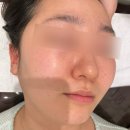 시원메디 | 광주피부관리 데자뷰메디스킨 후기 수분 열감 낮추기