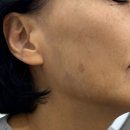 흑자제거 리팟레이저 후기 (밴스의원 명동2호점 방문)