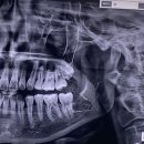 이화사랑약국 | 홍대 사랑이아프니 매복 사랑니 발치후기