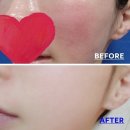 신생사 | 홍조 치료 단계별 관리 방법부터 원인별 치료 소개 및 시술 후기