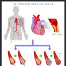 허혈심장질환진단(간편가입Ⅴ)보장 특별약관 (허혈심장질환진단의 정의 및 진단확정) 이미지