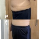 압구정웰약국 | 압구정피부과 지방분해주사 복부 뉴핏주사 솔직 찐후기