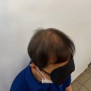 대구탈모관리 smp 전문점 블랙인스칼프 덕에 매우 만족한 울 아빠~