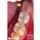 이수프라자약국 | 사당동치과 매복사랑니 발치 후 통증과 붓기, 4일째 아파도 정상인가요? - 언제까지 지속될까