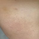 장세용비뇨기과의원 | [이천/피부과] 피부 두드러기 고친 후기