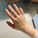 척병원 | [2편] 30대 팔꿈치 골수자극재생술 상세후기, 테니스엘보 경과후기_분당척병원