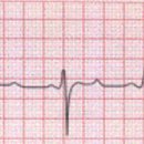 (펀글)애플 워치, 갤럭시 워치 심전도 부정맥 보는 방법 – 심실조기수축(Premature Ventricular Contraction, 이미지