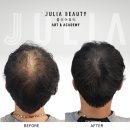 쥴리아 | 송파 가든파이브 줄리아뷰티 남자 정수리 전두부 탈모 커버 후기