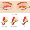 리뷰;분당성형외과 눈성형 쌍꺼풀수술 부분절개 절개- 절개법과 부분절개법 이미지