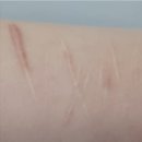 닥터우신경외과의원 | 자해흉터 주저흔 치료 새로운 방법_울트라펄스알파 레이저 사용 후기(피부과전문의)