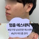 피코헬스케어 | 결혼 전 예비신랑 여드름•속건조 피부관리 | 압구정 남성 피부관리샵 멈춤에스테틱 (feat. 본식 10...