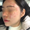 대웅한방병원 | 서울 편평사마귀성지 비립종제거 쥐젖무제한 사가정 내돈내산후기