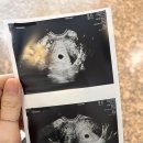유산1 | 시험관1차 임신 7주 계류유산 후기 소파술과정