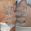 심HC | 아기 몸통 발진, 아토피일까? ㅣ 4개월 망고 진료 기록 ㅣ 스테로이드 연고 등급과 주의사항 (락티손...