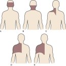 Cervical Spondylosis 이미지