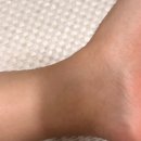 목낀때빼 | [직후] 팔 지방흡입 신사역병원 정보 후기 준비물 엄청 자세히 알려드려요