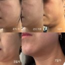 용문슈퍼 | [대전] 이중턱 / 윤곽관리 슈퍼브이턱 '비올렛뷰티&amp;왁싱': 2회차 후기