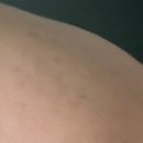 없습니다 | 이소티논 6개월 솔직후기/끼워파는 광고없습니다. 진짜 찐 후기/부작용