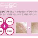 신재한의원 | [강남피부과] 나도 모르게 처들어온 적!! [여드름흉터제거]