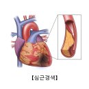 불안정형 협심증[Unstable angina]순환기질환 이미지