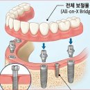 쌍문창치과기공소 | 무치악 뜻? 상악, 하악 무치악까지 치료 방법도 한 번에 확인하세요