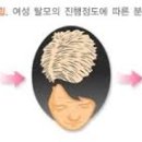 탈모퀸 이미지
