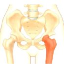 고관절인공관절/낙상으로 인한 고관절 골절 수술 이미지