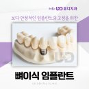 유디치과빌딩 | 부산 중구 남포동치과 65세 이상 임플란트 턱뼈 부족하다면 어떻게 진행할까?