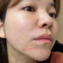 정맥환경㈜ 제2공장 | 강남역 피부과 줄기세포주사 후기｜효과, 멍, 가격 3주차 리얼 변화