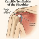 어깨 석회화건염 (Calcific Tendinitis of the Shoulder)에 대하여
