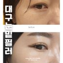반월당역 | 대구 반월당역 피부과 눈밑필러 솔직 후기