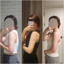 강남 팔뚝지방분해주사 2개월차 4회 후기 싹주사 가격