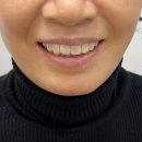 보정치과기공소 | 문정동 라미네이트 치료 후기 – 색상과 모양까지 자연스럽게!
