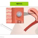 [난임과에서 하는 치료, 총 정리! +인공수정과 시험관 차이점]