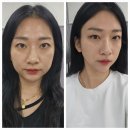 수지피부과에서 슈링크유니버스 받았어요. 효과, 통증, 솔직후기