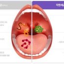 충치 치료 잇몸 염증 치은염 치아 신경치료 후 통증 이미지