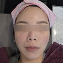 미래한의원 | 홍대 해율한의원에서 여드름흉터치료 받아본 솔직 후기