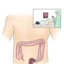 이유없는 복통, 잦은설사 대장암 초기? (대장암 원인, ) 이미지