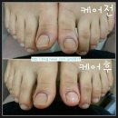 복대패 이미지
