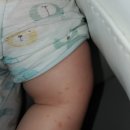 PPO뿅뿅 | 18개월 아기 소아 물사마귀 원인, 증상, 치료법, 홈케어 #미국얼바인피부과추천