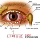 마이봄샘(눈꺼풀 안쪽 피지선) 이미지