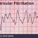 급사 위험이 높은 부정맥 심실세동 심실빈맥에 대해 이미지