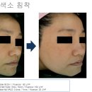 화인메디테크 네이버블로그
