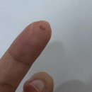 티나성형외과 | 수면마취 아이라인 문신 제거 컴포트성형외과 #내돈내산 후기