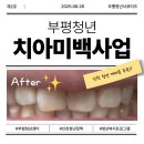 뉴미시간치과의원 | 유유기지 부평 청년 치아미백검진사업 후기! 🦷✨ (+연세미시간치과)