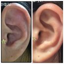 귀건강이혈테라피 | [이혈 테라피란?] 귀에 자극을 주면 몸이 좋아지는 이유 | 올가드림뷰티 여수진남점