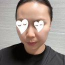 몽그리몽 | 이마 화이트헤드 블랙헤드 피지 싹 없앰